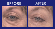 Wrinkles - Before & After