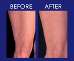 Cellulite Clay Wrap - Before & After