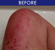 Eczema/Psoriasis - Before & After
