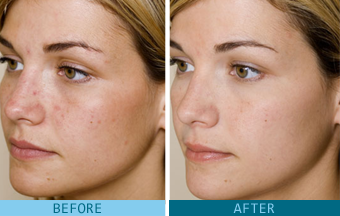 GLYCOLIC ACID BEFORE & AFTER