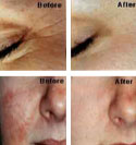 Before & After Acne - Wrinkle